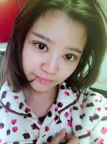 雙眼皮+開眼角3個月恢復過程圖