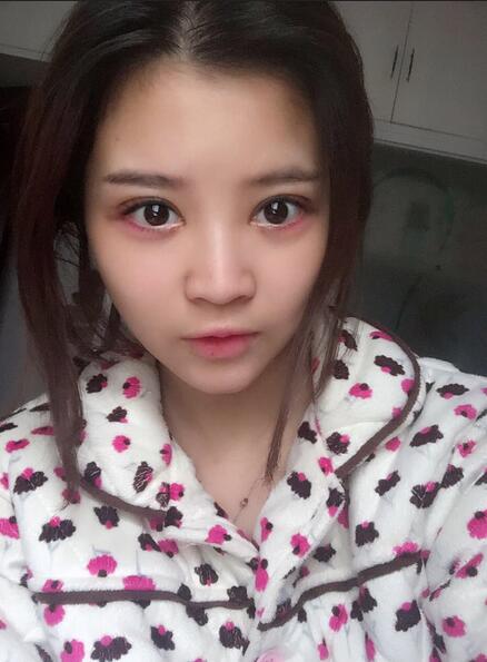 雙眼皮+開眼角3個月恢復過程圖