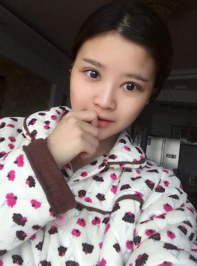 雙眼皮+開眼角3個月恢復過程圖