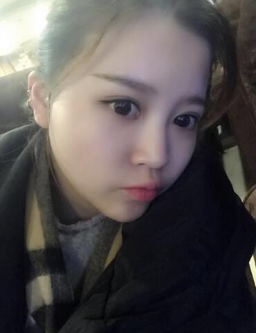 雙眼皮+開眼角3個月恢復過程圖