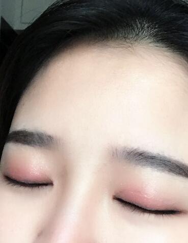 雙眼皮+開眼角3個月恢復過程圖