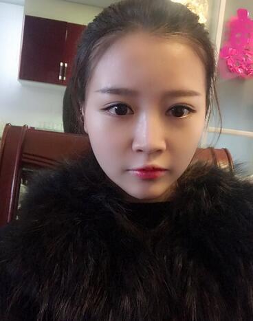 雙眼皮+開眼角3個月恢復過程圖