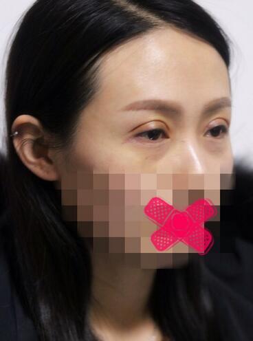 北京麗星雙眼皮修復(fù)半年了