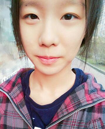 微創(chuàng)定點(diǎn)每天恢復(fù)過程圖 北京麗星雙眼皮3個(gè)月