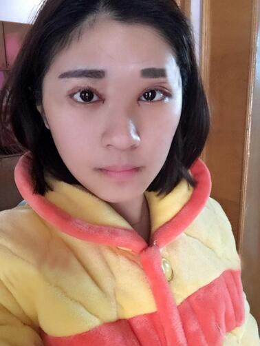 微創(chuàng)定點(diǎn)每天恢復(fù)過程圖 北京麗星雙眼皮3個(gè)月