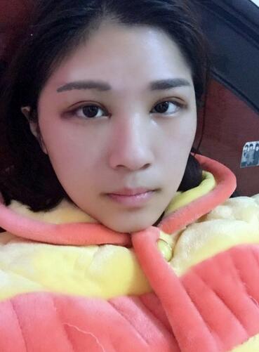 微創(chuàng)定點(diǎn)每天恢復(fù)過程圖 北京麗星雙眼皮3個(gè)月