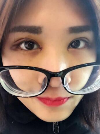 微創(chuàng)定點(diǎn)每天恢復(fù)過程圖 北京麗星雙眼皮3個(gè)月