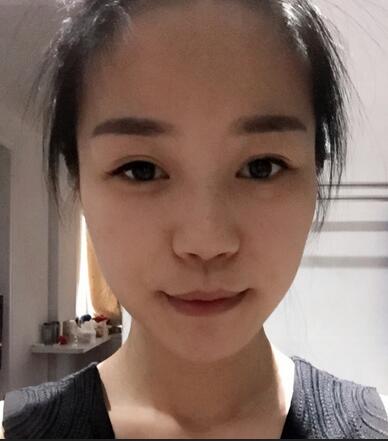 硅膠隆鼻前后對比 硅膠隆鼻+鼻小柱延長恢復日記