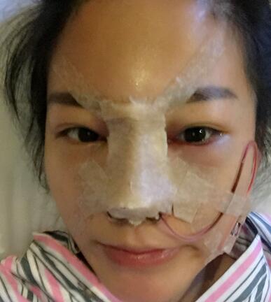 硅膠隆鼻前后對比 硅膠隆鼻+鼻小柱延長恢復日記