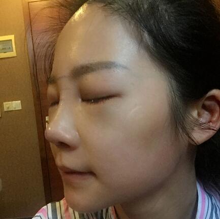 硅膠隆鼻前后對比 硅膠隆鼻+鼻小柱延長恢復日記