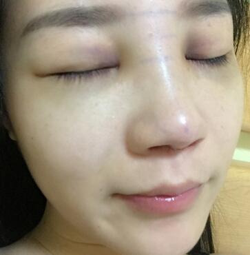硅膠隆鼻前后對比 硅膠隆鼻+鼻小柱延長恢復日記