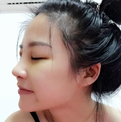 硅膠隆鼻前后對比 硅膠隆鼻+鼻小柱延長恢復日記