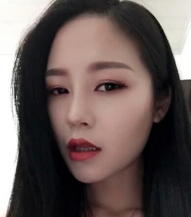 硅膠隆鼻前后對比 硅膠隆鼻+鼻小柱延長恢復日記