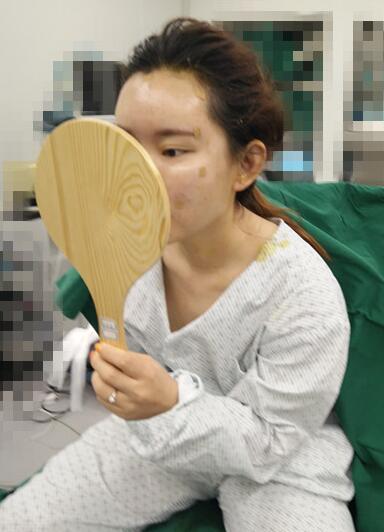 詳細(xì)部脂肪填充果圖 術(shù)后恢復(fù)分享