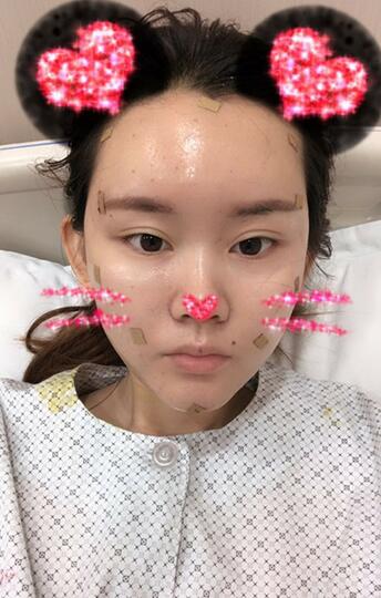 詳細(xì)部脂肪填充果圖 術(shù)后恢復(fù)分享