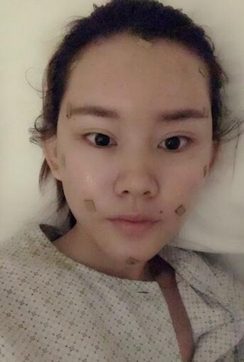 詳細(xì)部脂肪填充果圖 術(shù)后恢復(fù)分享