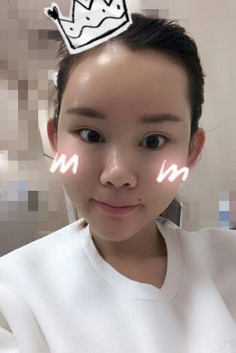 詳細(xì)部脂肪填充果圖 術(shù)后恢復(fù)分享