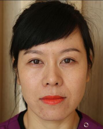 面部埋埋蛋白線.提升恢復(fù)過程分享