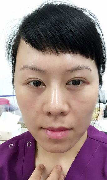 面部埋埋蛋白線.提升恢復(fù)過程分享