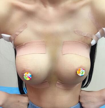 假體隆胸術(shù)后恢復(fù)3個月紀(jì)實