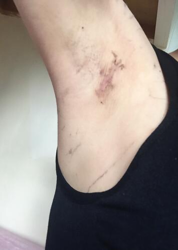 假體隆胸術(shù)后恢復(fù)3個月紀(jì)實