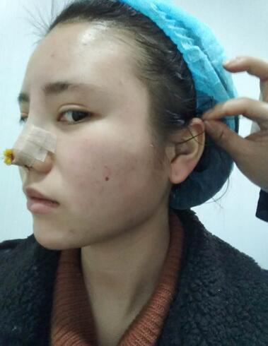 耳軟骨墊鼻尖一個月圖