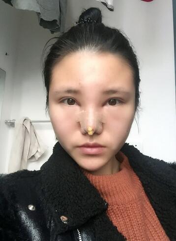 耳軟骨墊鼻尖一個月圖