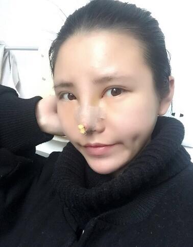 耳軟骨墊鼻尖一個月圖