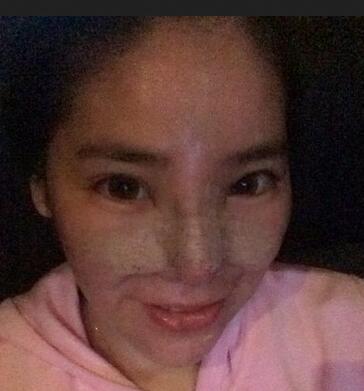 隆鼻整形2個(gè)月恢復(fù)日記 硅膠隆鼻+鼻翼縮小