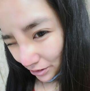 隆鼻整形2個(gè)月恢復(fù)日記 硅膠隆鼻+鼻翼縮小