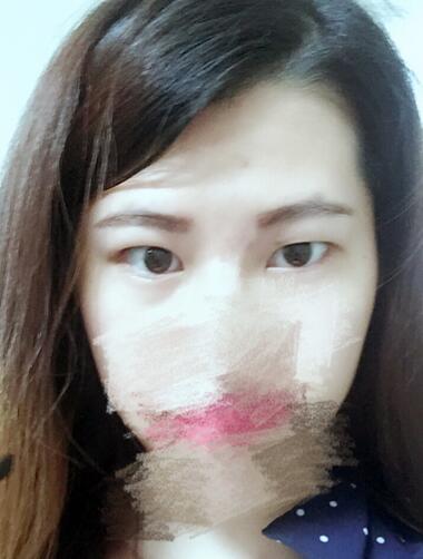 切開重瞼術(shù)恢復(fù)過程圖