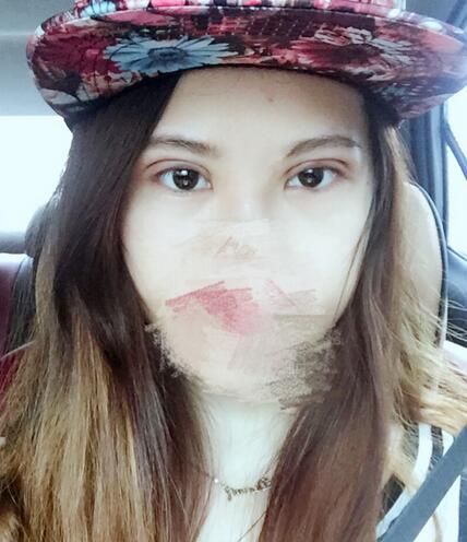 切開重瞼術(shù)恢復(fù)過程圖