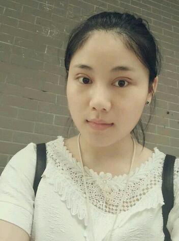 全切雙眼皮半年恢復(fù)過程圖