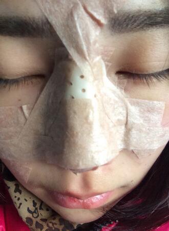 耳軟骨墊鼻尖三個(gè)月圖 耳軟骨墊鼻尖+硅膠隆鼻
