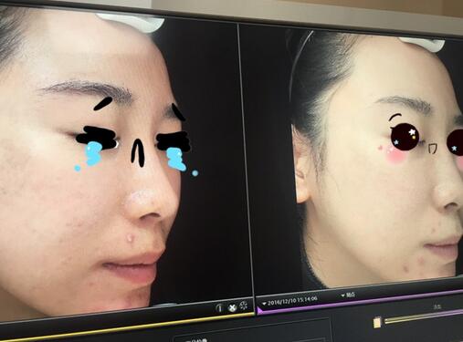 做完光子嫩膚恢復(fù)圖片 果滿滿