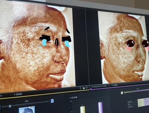 做完光子嫩膚恢復(fù)圖片 果滿滿