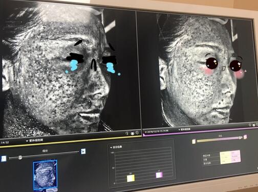 做完光子嫩膚恢復(fù)圖片 果滿滿