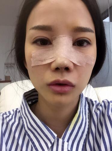隆鼻整形真實(shí)恢經(jīng)歷 曬圖啦！