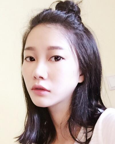 隆鼻整形真實(shí)恢經(jīng)歷 曬圖啦！