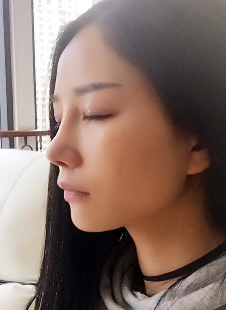 隆鼻整形真實(shí)恢經(jīng)歷 曬圖啦！