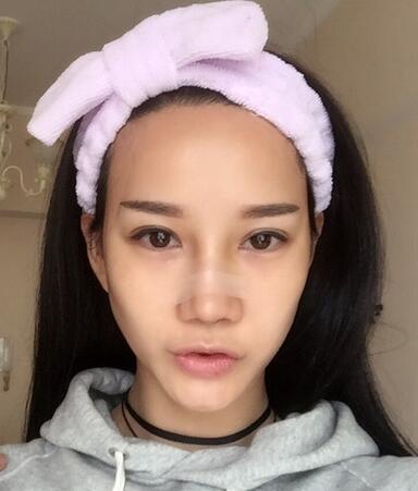 隆鼻整形真實(shí)恢經(jīng)歷 曬圖啦！