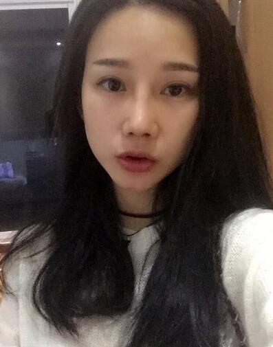 隆鼻整形真實(shí)恢經(jīng)歷 曬圖啦！