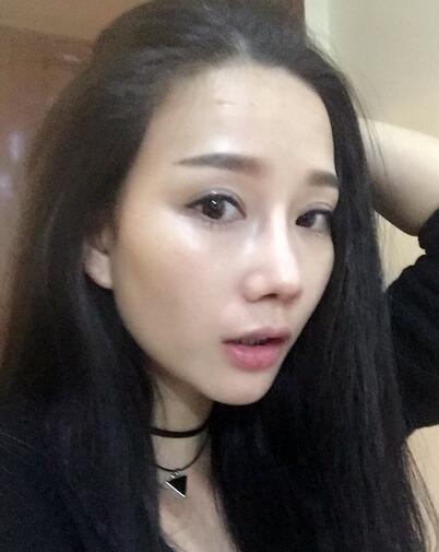 隆鼻整形真實(shí)恢經(jīng)歷 曬圖啦！