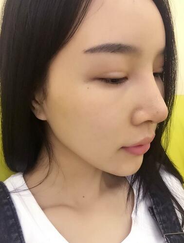 鼻修復(fù)后的恢復(fù)期經(jīng)歷分享