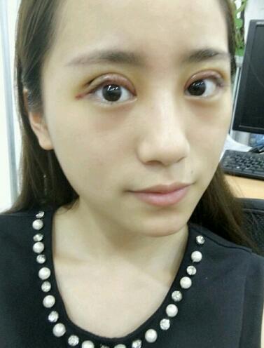 割雙眼皮案例圖片 雙眼皮手術20天