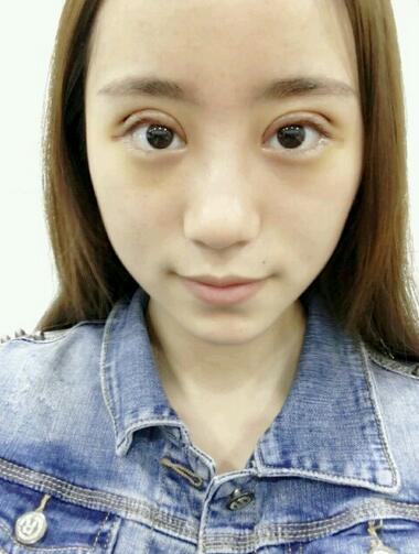 割雙眼皮案例圖片 雙眼皮手術20天