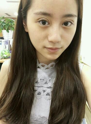 割雙眼皮案例圖片 雙眼皮手術20天