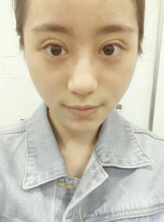 割雙眼皮案例圖片 雙眼皮手術20天