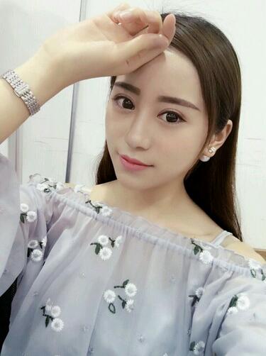 割雙眼皮案例圖片 雙眼皮手術20天