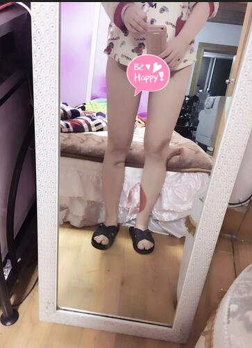 自體脂肪豐胸恢復(fù)正常需要多久 我的經(jīng)歷告訴你